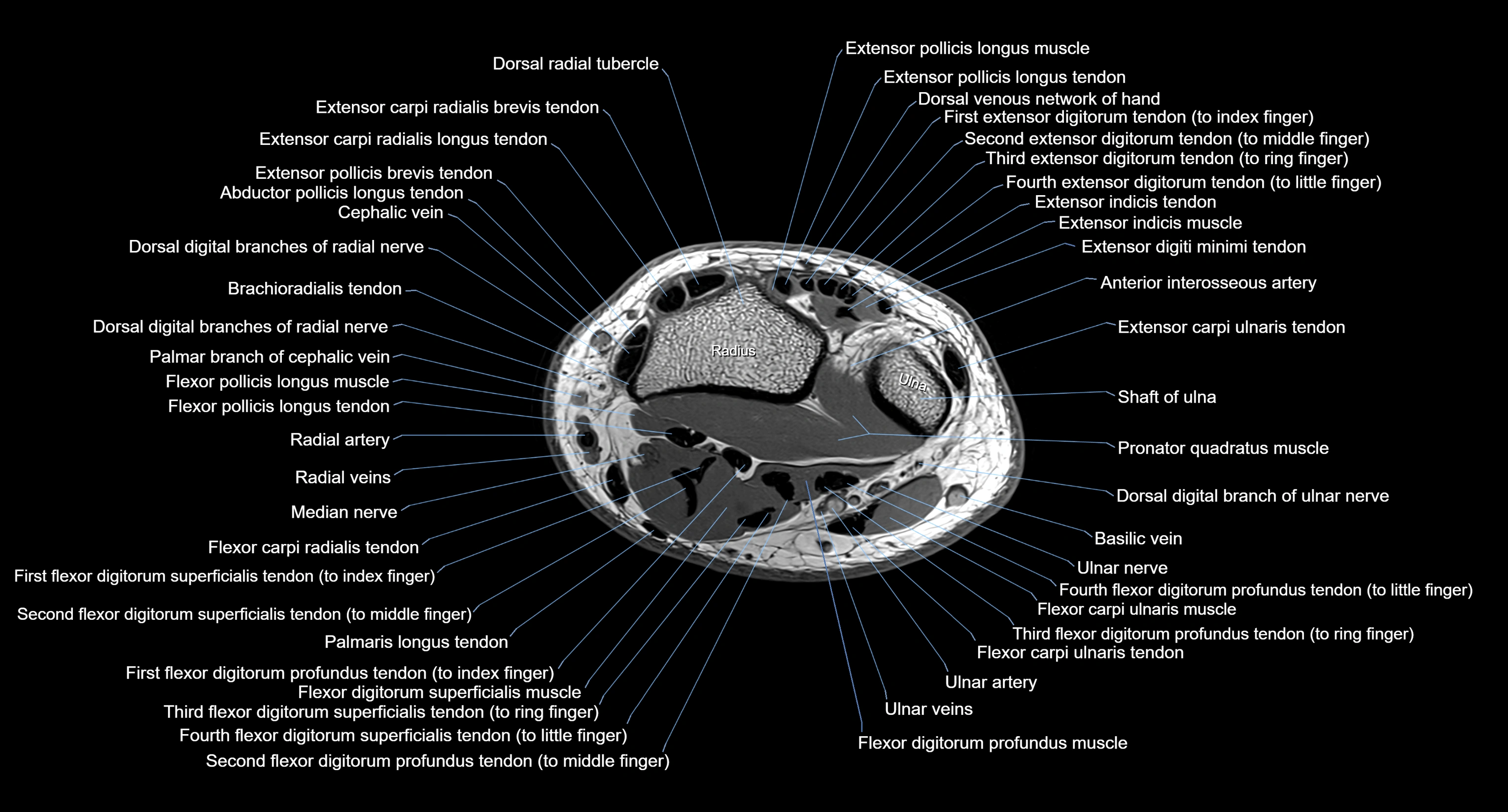 MRI wrist axial cross sectional anatomy 3T radiology  image-img-00001-00031.webp
